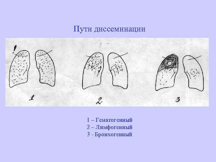 Пути диссеминации 1 – Гематогенный 2 – Лимфогенный 3 - Бронхогенный 