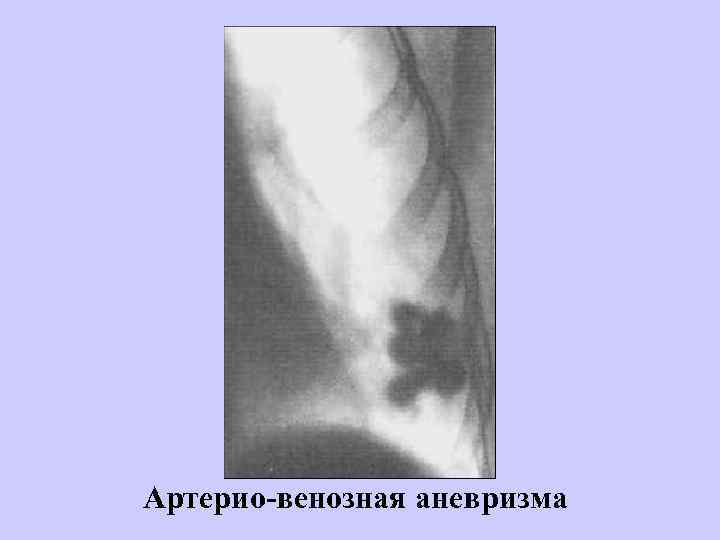 Артерио-венозная аневризма 