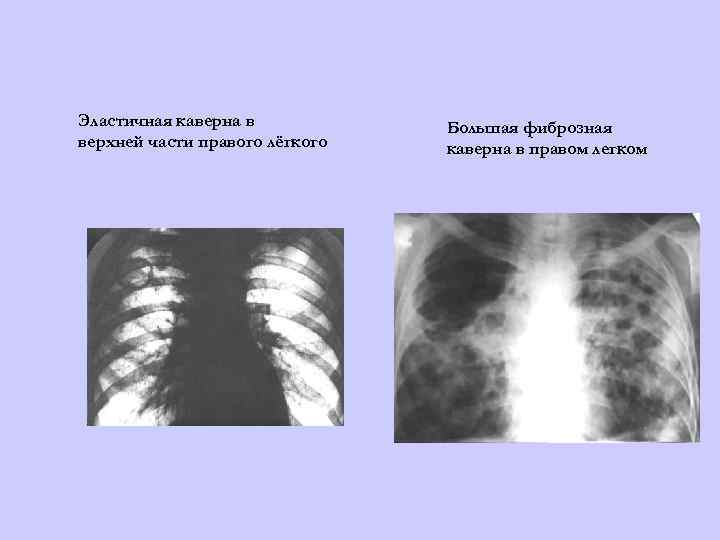 Эластичная каверна в верхней части правого лёгкого Большая фиброзная каверна в правом легком 