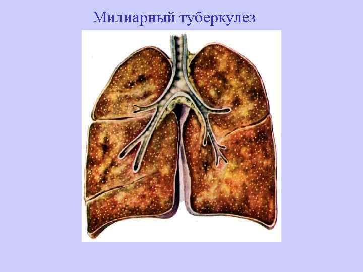 Милиарный туберкулез 