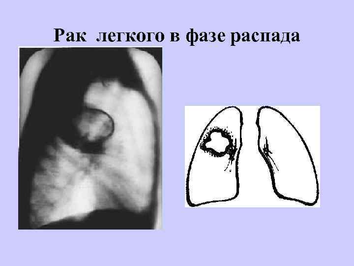 Рак легкого в фазе распада 
