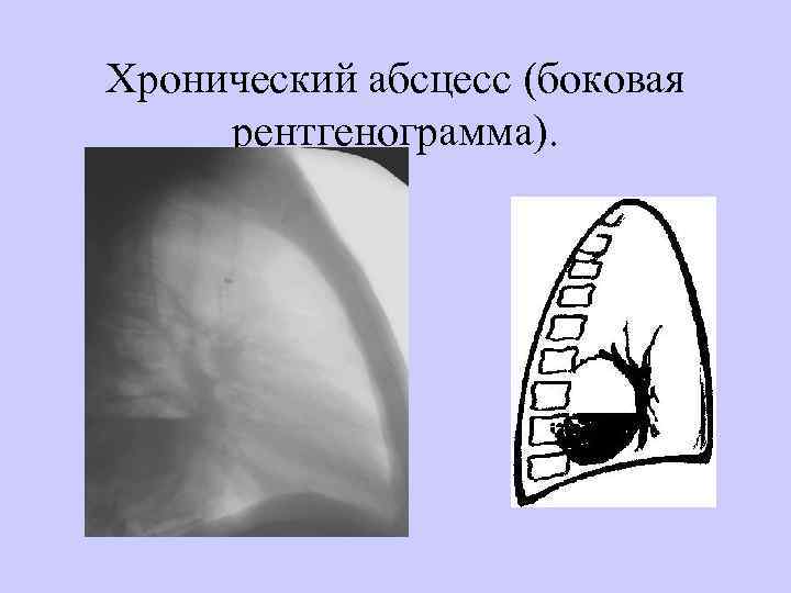 Хронический абсцесс (боковая рентгенограмма). 
