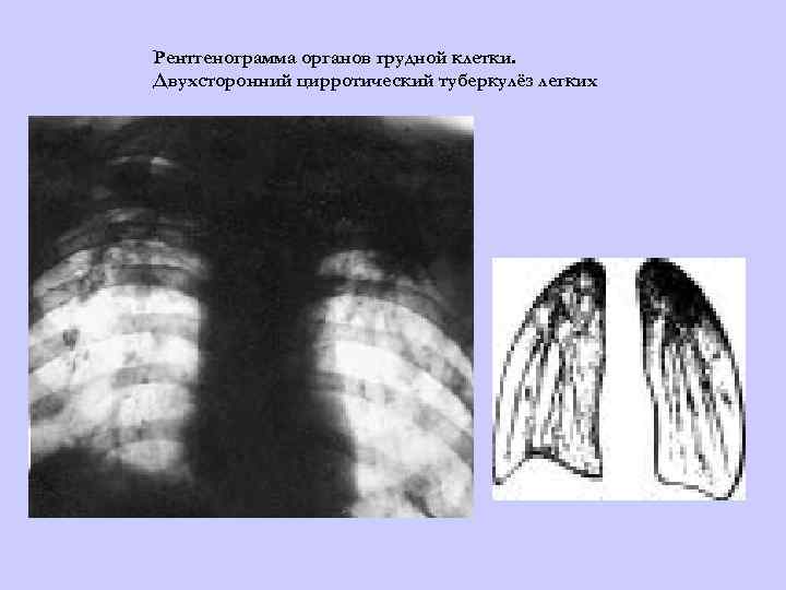 Рентгенограмма органов грудной клетки. Двухсторонний цирротический туберкулёз легких 