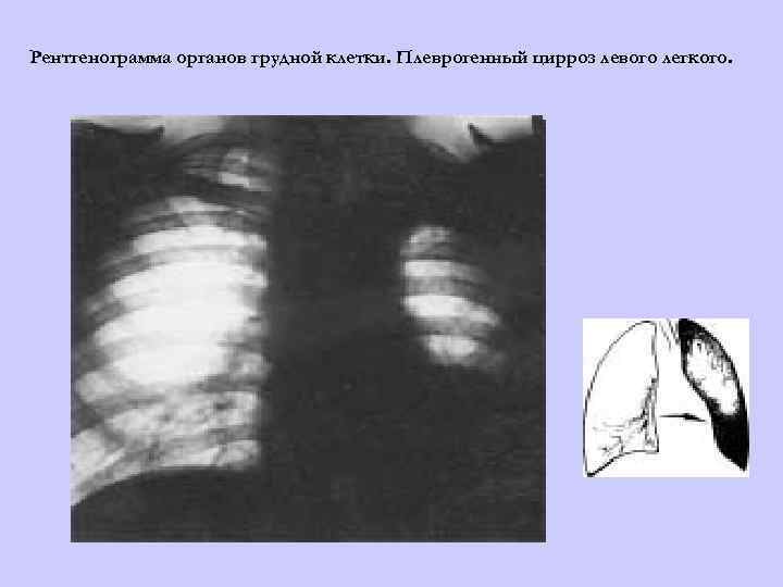 Рентгенограмма органов грудной клетки. Плеврогенный цирроз левого легкого. 