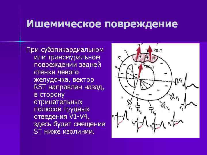 Ишемическое повреждение При субэпикардиальном или трансмуральном повреждении задней стенки левого желудочка, вектор RST направлен