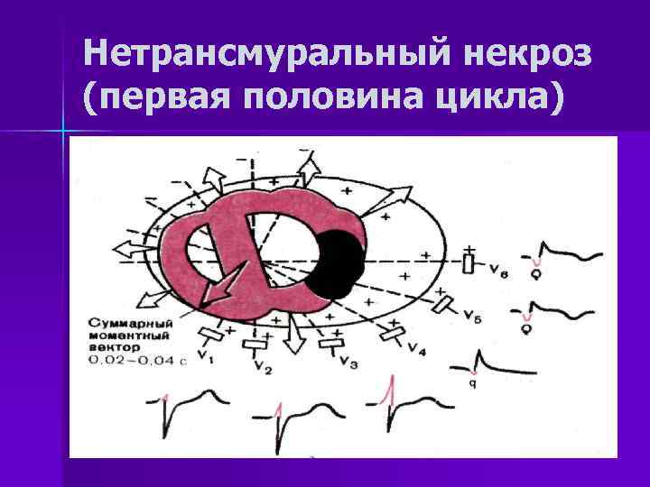 Нетрансмуральный некроз (первая половина цикла) 
