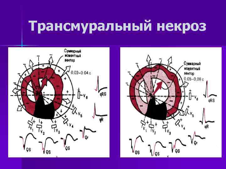 Трансмуральный некроз 