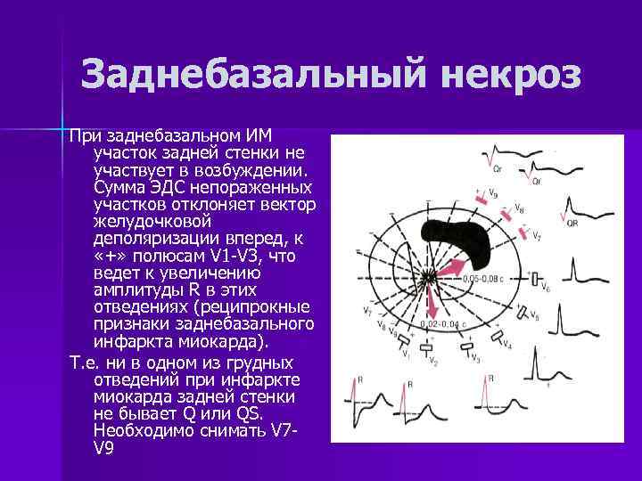 Заднебазальный некроз При заднебазальном ИМ участок задней стенки не участвует в возбуждении. Сумма ЭДС