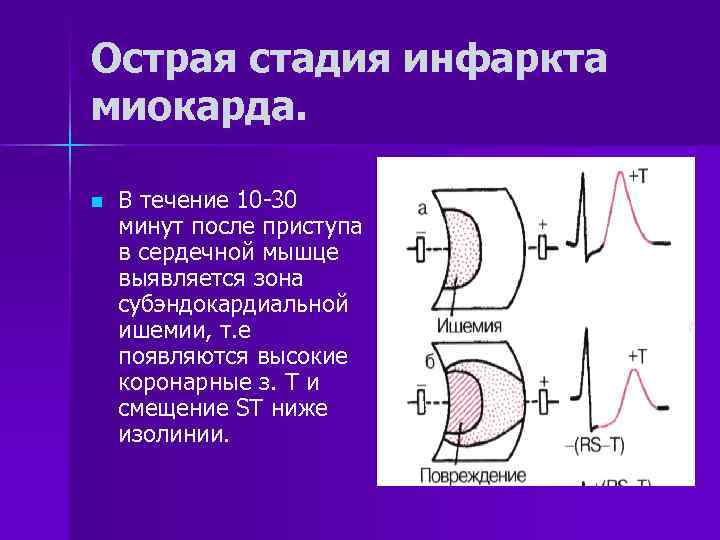 Субэндокардиальная ишемия передней стенки что это