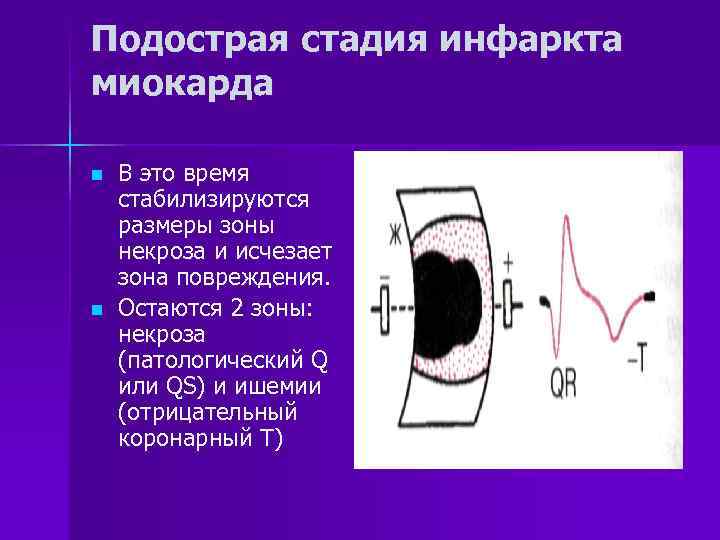Подострая стадия инфаркта миокарда n n В это время стабилизируются размеры зоны некроза и