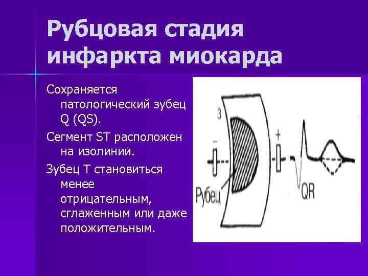 Рубцовая стадия инфаркта миокарда Сохраняется патологический зубец Q (QS). Сегмент ST расположен на изолинии.