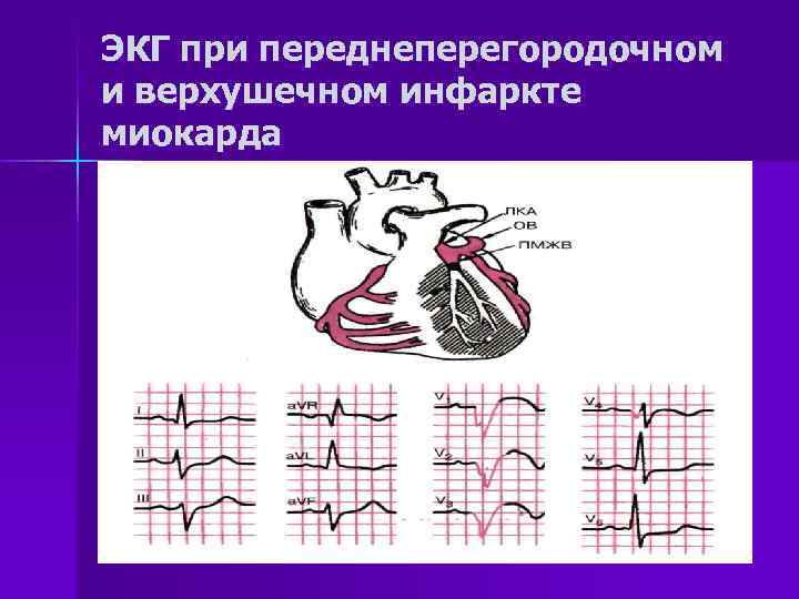 ЭКГ при переднеперегородочном и верхушечном инфаркте миокарда 