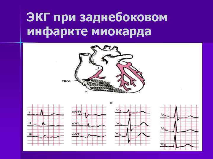 Стенки левого желудочка