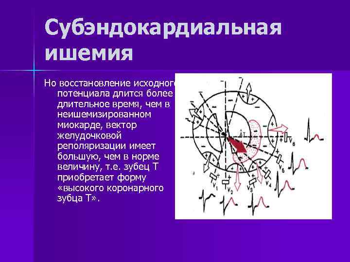 Субэндокардиальная ишемия Но восстановление исходного потенциала длится более длительное время, чем в неишемизированном миокарде,