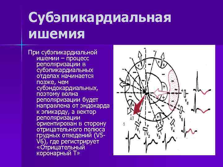 Субэпикардиальная ишемия При субэпикардиальной ишемии – процесс реполяризации в субэпикардиальных отделах начинается позже, чем