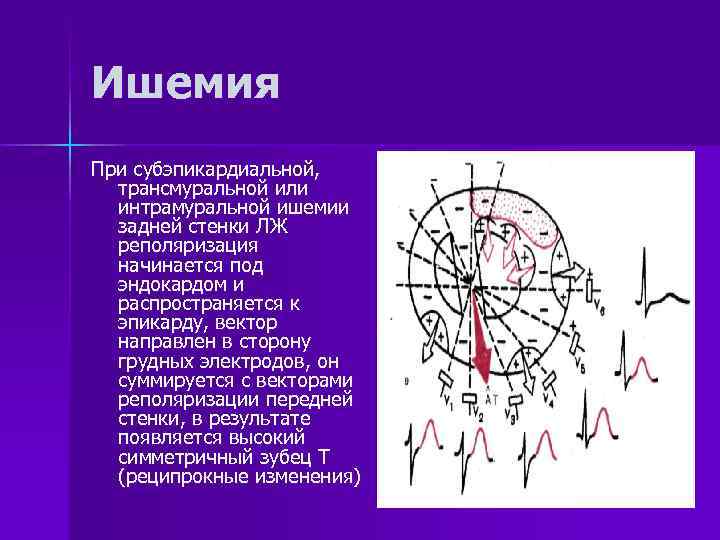 Ишемия При субэпикардиальной, трансмуральной или интрамуральной ишемии задней стенки ЛЖ реполяризация начинается под эндокардом
