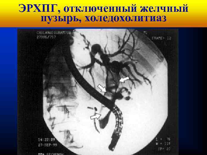Кафедра хирургических болезней ЭРХПГ, отключенный желчный № 1 пузырь, холедохолитиаз 