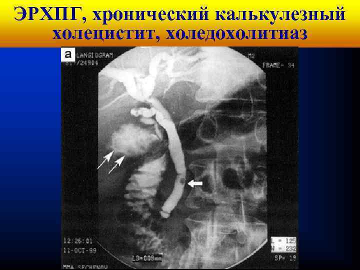 Кафедра хирургических болезней № 1 ЭРХПГ, хронический калькулезный холецистит, холедохолитиаз 
