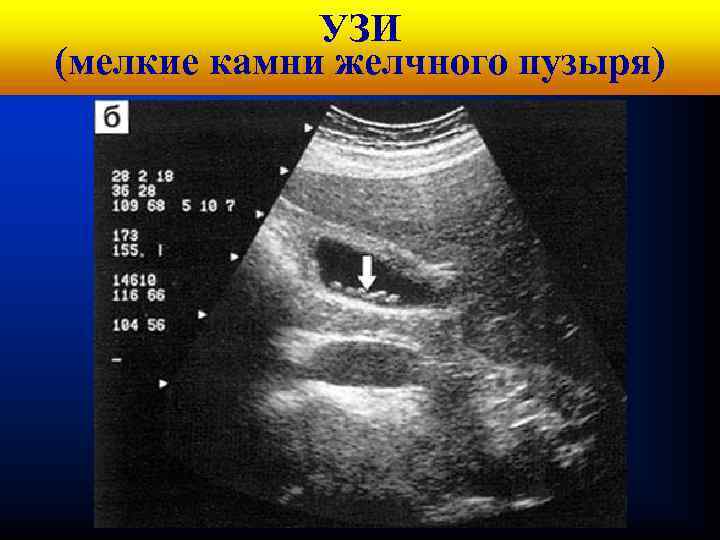 Кафедра УЗИ хирургических болезней № 1 (мелкие камни желчного пузыря) 