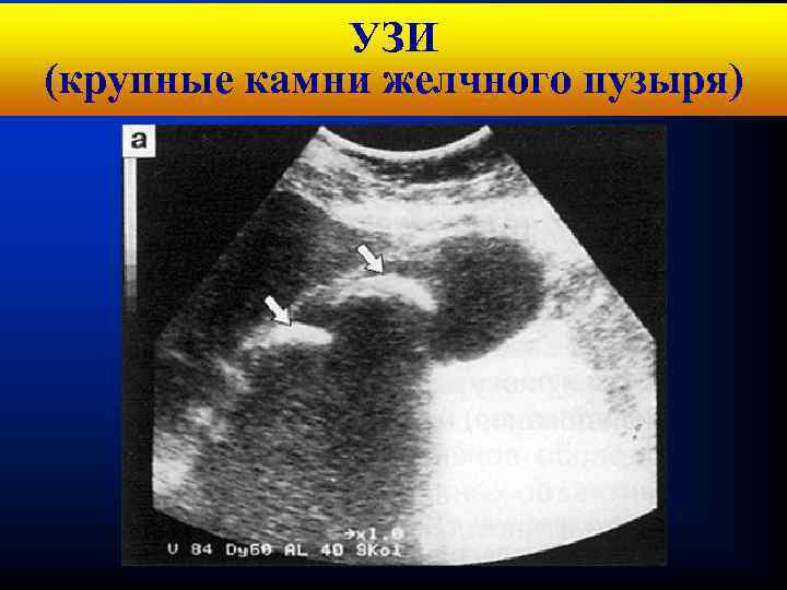 Кафедра хирургических болезней № 1 УЗИ (крупные камни желчного пузыря) 