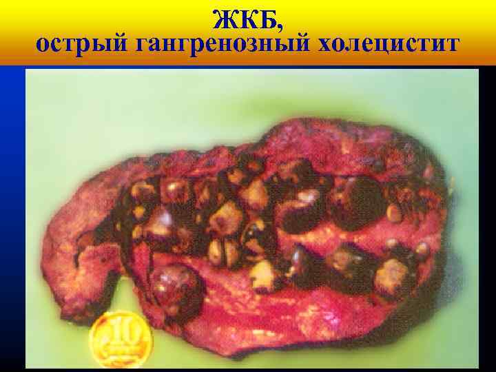 Кафедра ЖКБ, хирургических болезней № 1 острый гангренозный холецистит 