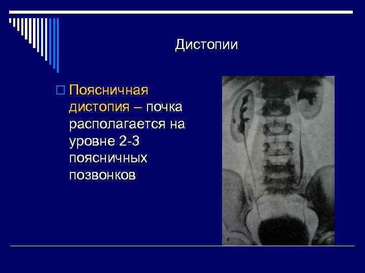 Дистопии o Поясничная дистопия – почка располагается на уровне 2 -3 поясничных позвонков 