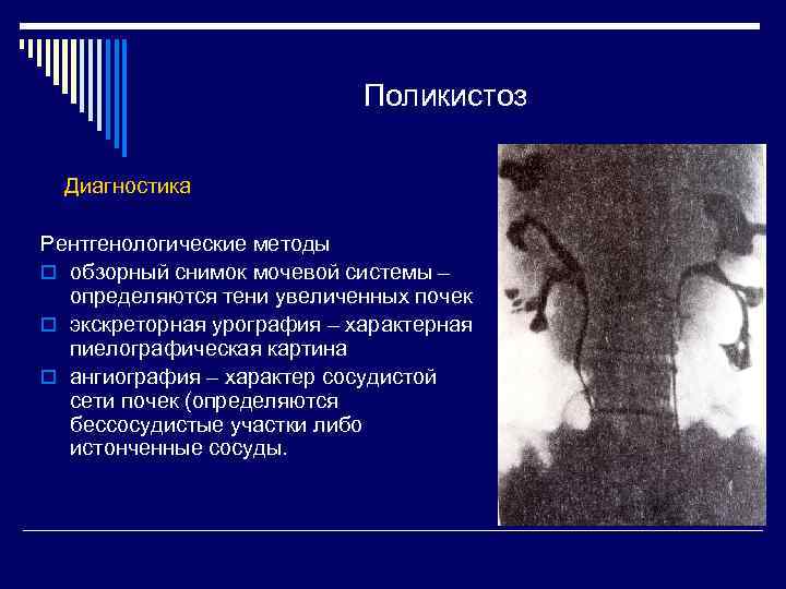 Поликистоз Диагностика Рентгенологические методы o обзорный снимок мочевой системы – определяются тени увеличенных почек