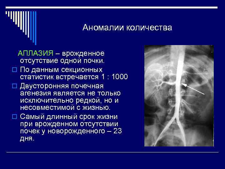 Аномалии количества АПЛАЗИЯ – врожденное отсутствие одной почки. o По данным секционных статистик встречается