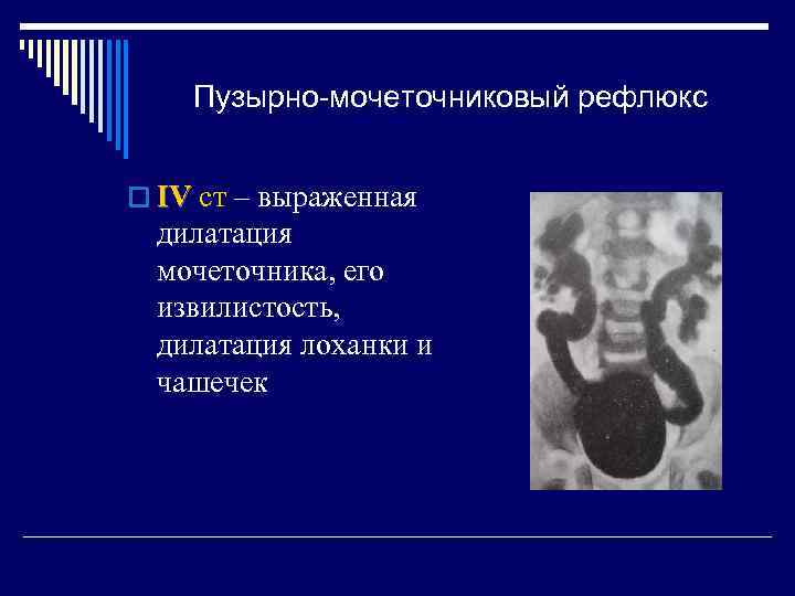 Пузырно-мочеточниковый рефлюкс o IV ст – выраженная дилатация мочеточника, его извилистость, дилатация лоханки и