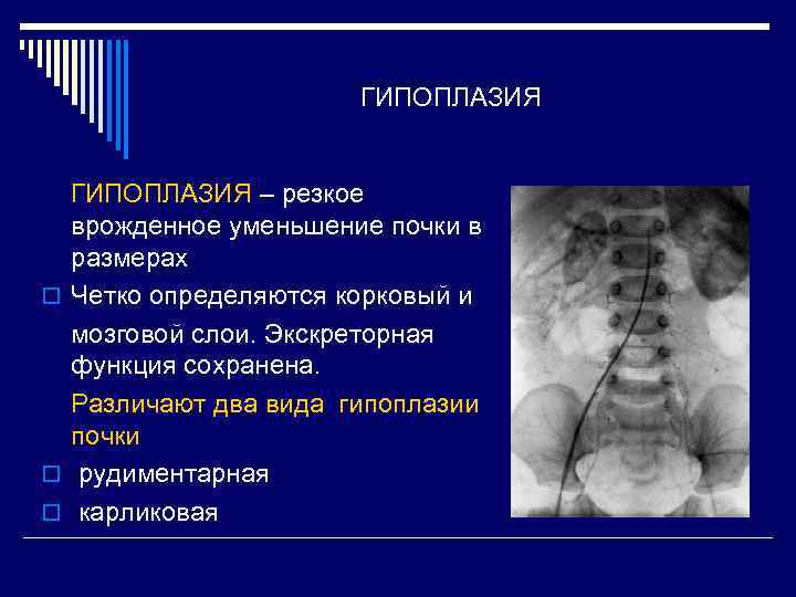 ГИПОПЛАЗИЯ – резкое врожденное уменьшение почки в размерах o Четко определяются корковый и мозговой
