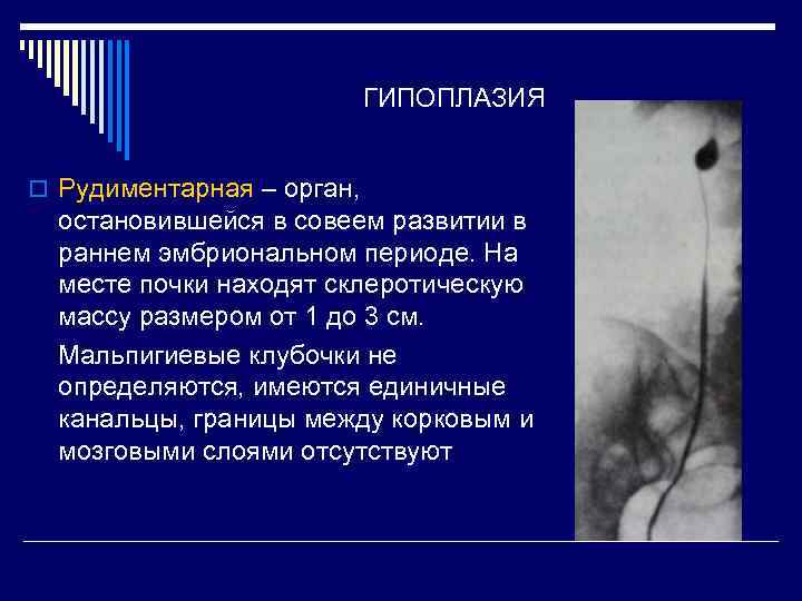 ГИПОПЛАЗИЯ o Рудиментарная – орган, остановившейся в совеем развитии в раннем эмбриональном периоде. На