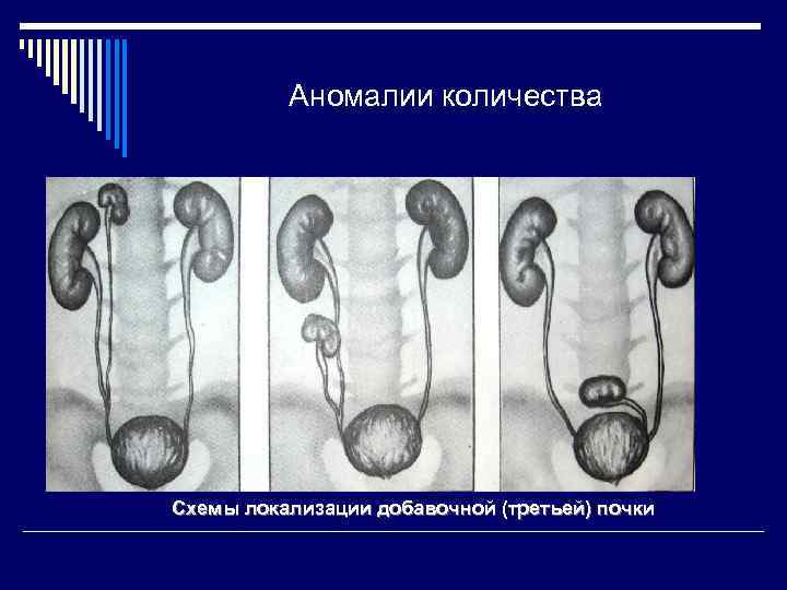 Аномалии количества Схемы локализации добавочной (третьей) почки 