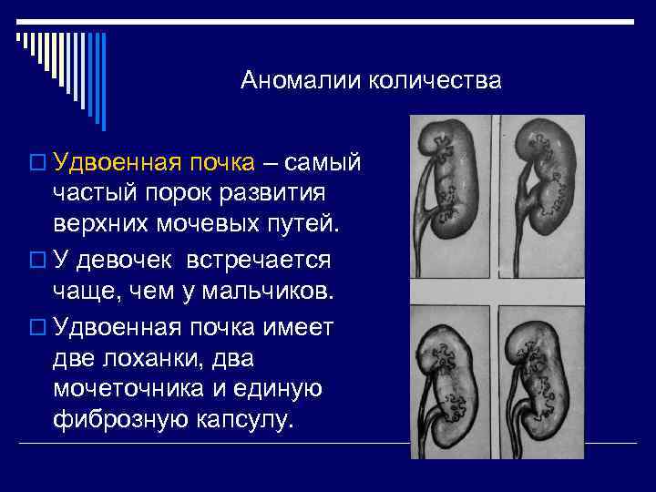 Аномалии количества o Удвоенная почка – самый частый порок развития верхних мочевых путей. o
