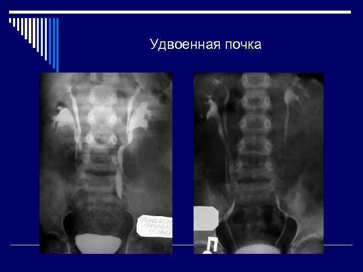 Удвоенная почка 