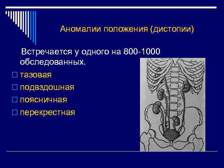 Аномалии положения (дистопии) Встречается у одного на 800 -1000 обследованных. o тазовая o подвздошная