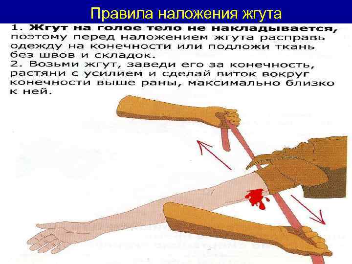 Правила наложения жгута 