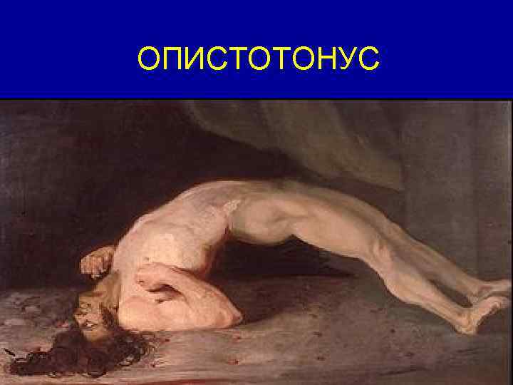 ОПИСТОТОНУС 