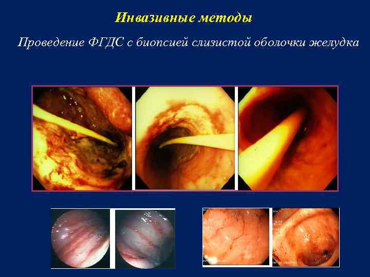 Инвазивные методы Проведение ФГДС с биопсией слизистой оболочки желудка 