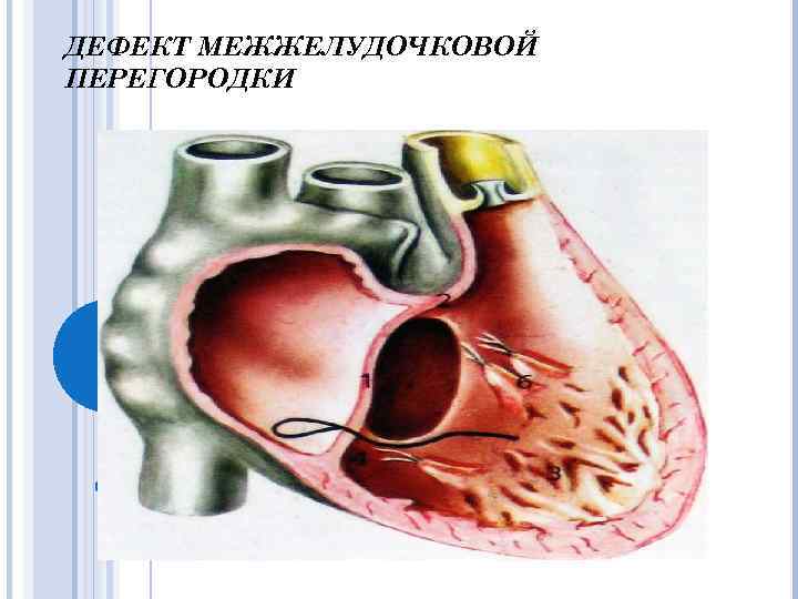 Дефект межжелудочковой перегородки фото