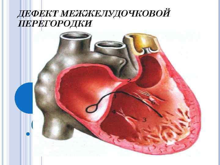 ДЕФЕКТ МЕЖЖЕЛУДОЧКОВОЙ ПЕРЕГОРОДКИ 