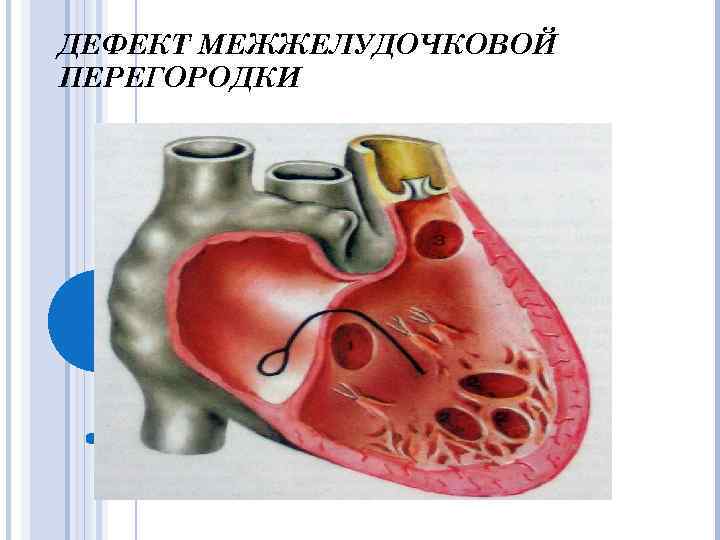 Дефект межжелудочковой перегородки