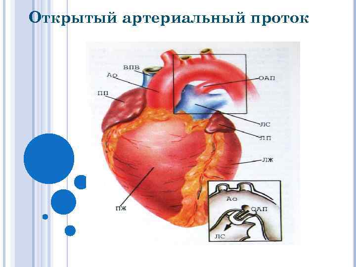 Открытый артериальный проток фото