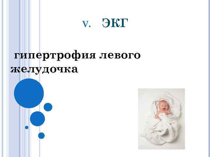 V. ЭКГ гипертрофия левого желудочка 