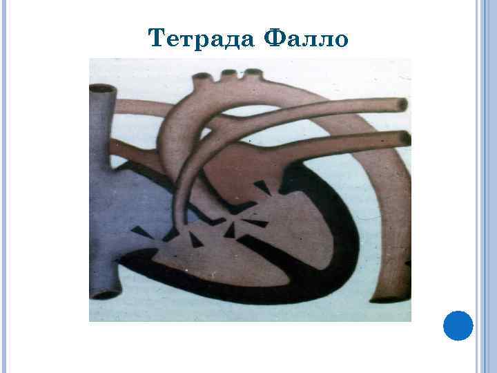 Тетрада Фалло 