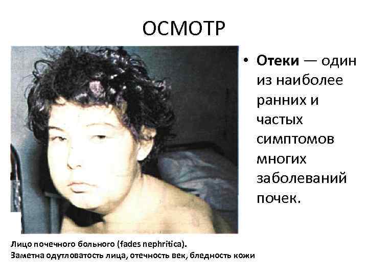 ОСМОТР • Отеки — один из наиболее ранних и частых симптомов многих заболеваний почек.