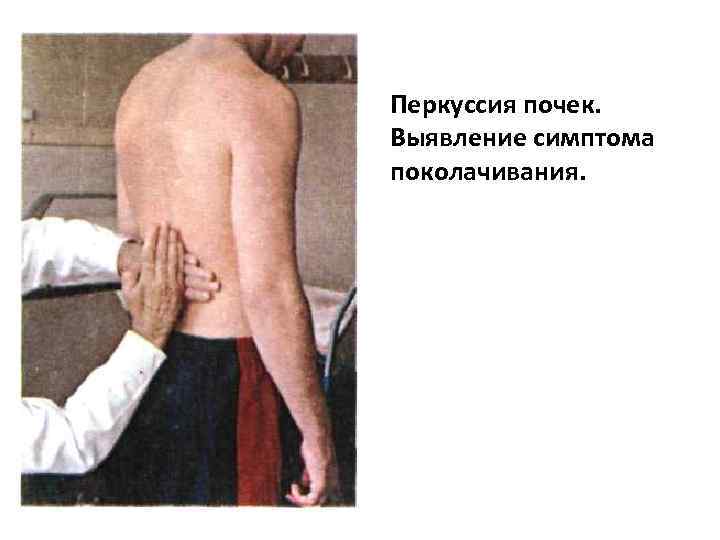 Перкуссия почек. Выявление симптома поколачивания. 