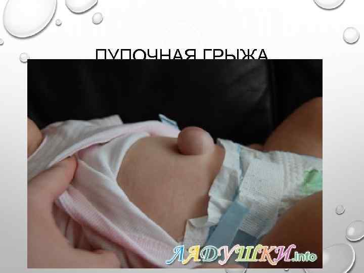 ПУПОЧНАЯ ГРЫЖА 