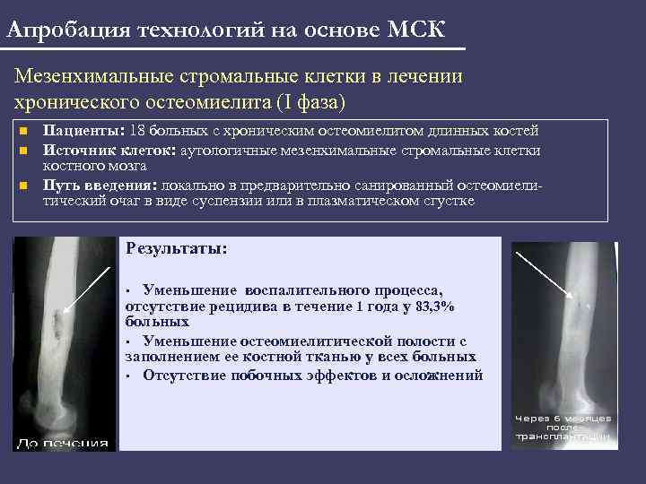 Апробация технологий на основе МСК Мезенхимальные стромальные клетки в лечении хронического остеомиелита (I фаза)