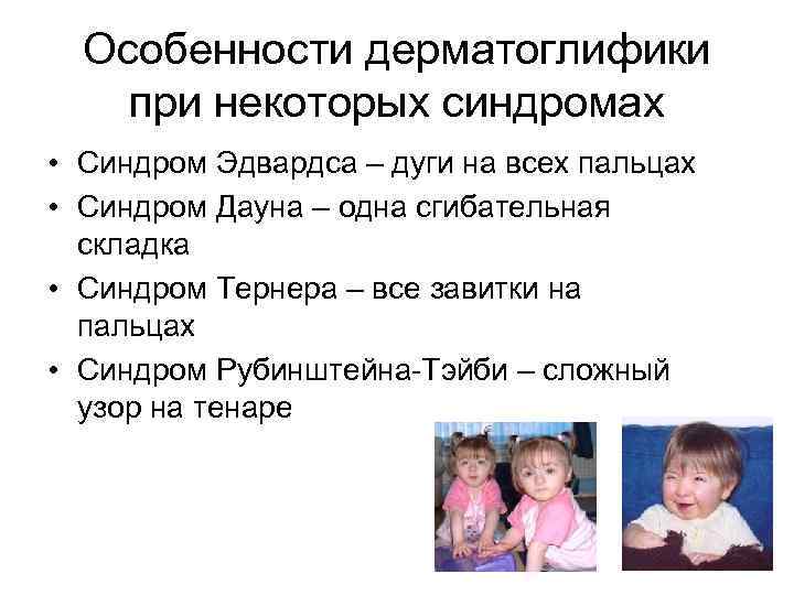 Особенности дерматоглифики при некоторых синдромах • Синдром Эдвардса – дуги на всех пальцах •