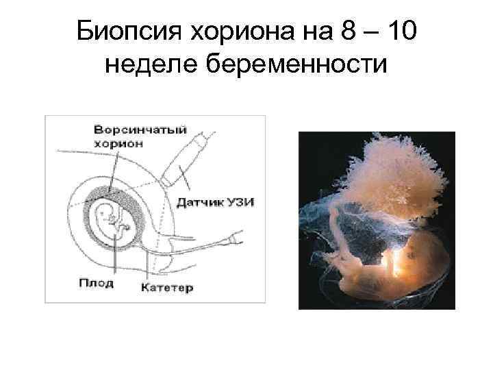 Биопсия хориона на 8 – 10 неделе беременности 